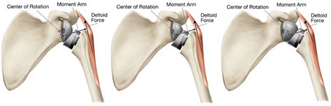 Biomechanical Summary of Reverse Shoulder Arthroplasty.